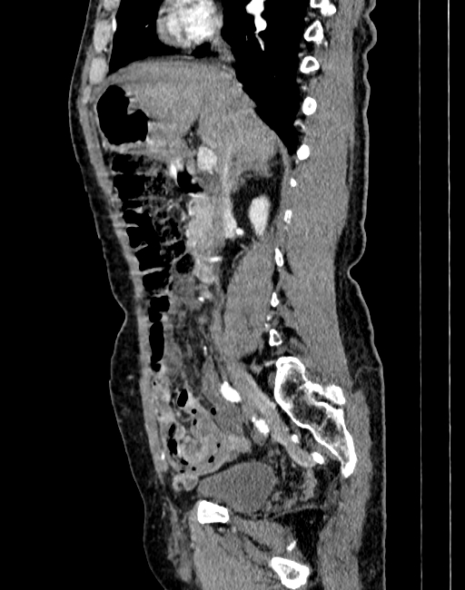 Abdominal aortic aneurysm (Radiopaedia 83581-98689 Sagittal C+ arterial phase 19).jpg