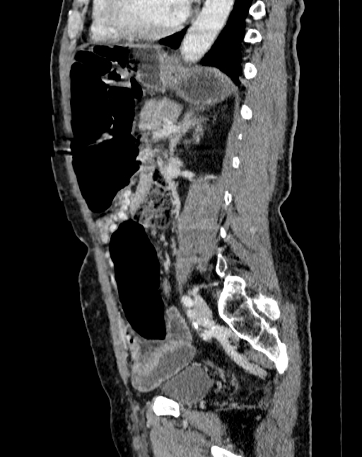 Abdominal aortic aneurysm (Radiopaedia 83581-98689 Sagittal C+ portal venous phase 76).jpg