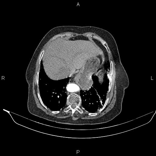 File:Abdominal aortic aneurysm (Radiopaedia 85063-100606 Axial C+ arterial phase 26).jpg