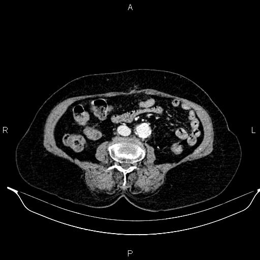 File:Abdominal aortic aneurysm (Radiopaedia 85063-100606 Axial C+ portal venous phase 44).jpg