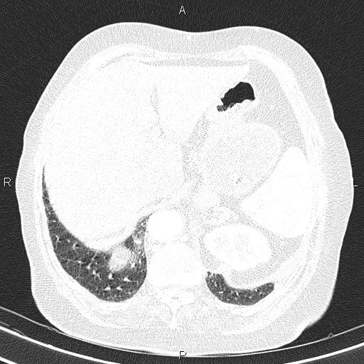 File:Abdominal aortic aneurysm (Radiopaedia 85063-100606 Axial lung window 59).jpg