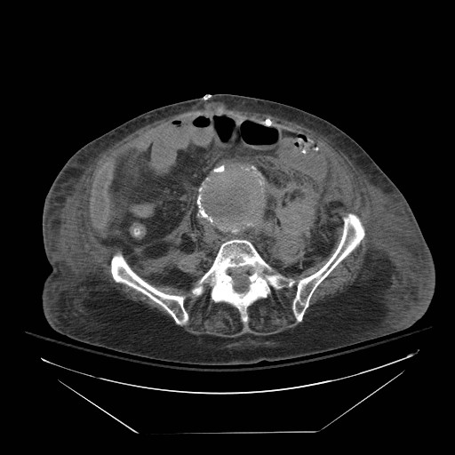 Abdominal aortic aneurysm - impending rupture (Radiopaedia 19233-19247 Axial non-contrast 111).jpg