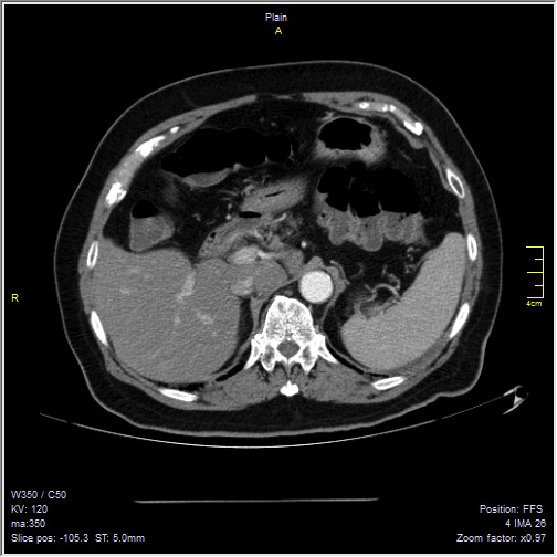 Abdominal aortic aneurysm with thrombus fissuration (Radiopaedia 47340-51926 Axial C+ arterial phase 10).jpg