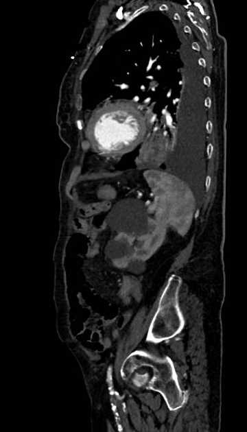 Abdominal aortic aneurysm with thrombus fissuration (Radiopaedia 73192-83919 Sagittal C+ arterial phase 32).jpg