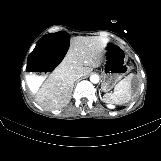 File:Abdominal collection due to previous cecal perforation (Radiopaedia 80831-94320 Axial C+ portal venous phase 41).jpg