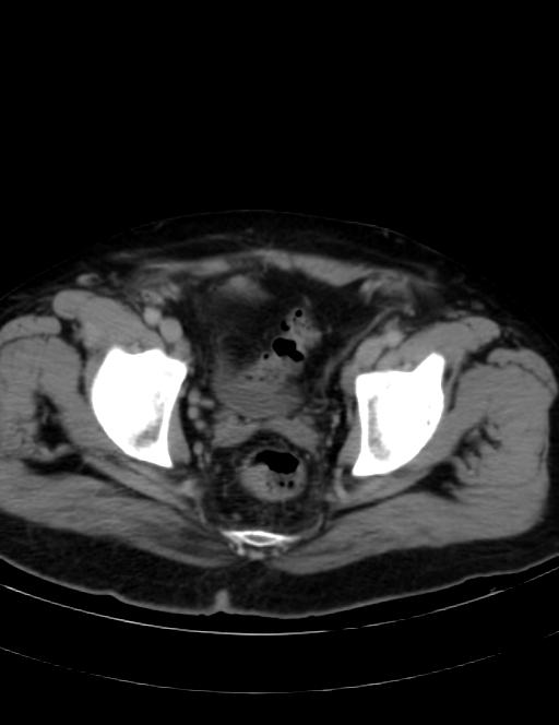 Abdominal lymphoma - with sandwich sign (Radiopaedia 53486-59492 Axial C+ portal venous phase 46).jpg