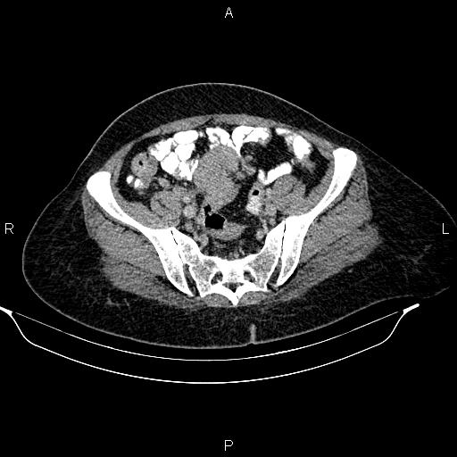 File:Abdominal lymphoma with sandwich sign (Radiopaedia 84378-99704 Axial C+ portal venous phase 45).jpg