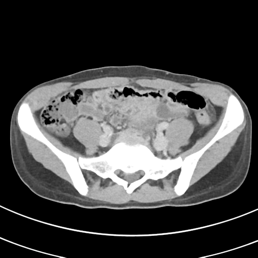 File:Abdominal multi-trauma - devascularised kidney and liver, spleen and pancreatic lacerations (Radiopaedia 34984-36486 Axial C+ delayed 57).png