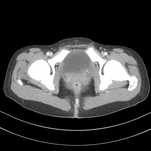 File:Abdominal multi-trauma - devascularised kidney and liver, spleen and pancreatic lacerations (Radiopaedia 34984-36486 Axial C+ portal venous phase 81).png
