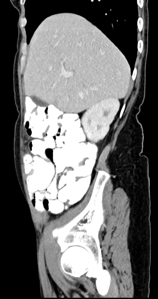 Abdominal wall and retroperitoneal tuberculosis (Radiopaedia 88137-104729 Sagittal C+ portal venous phase 114).jpg
