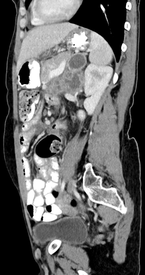 Abdominal wall and retroperitoneal tuberculosis (Radiopaedia 88137-104729 Sagittal C+ portal venous phase 57).jpg