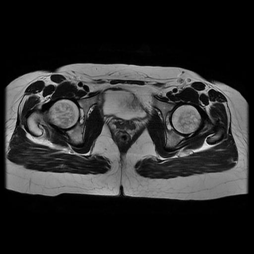 File:Abdominal wall endometriosis (Radiopaedia 83702-98847 Axial T2 15).jpg