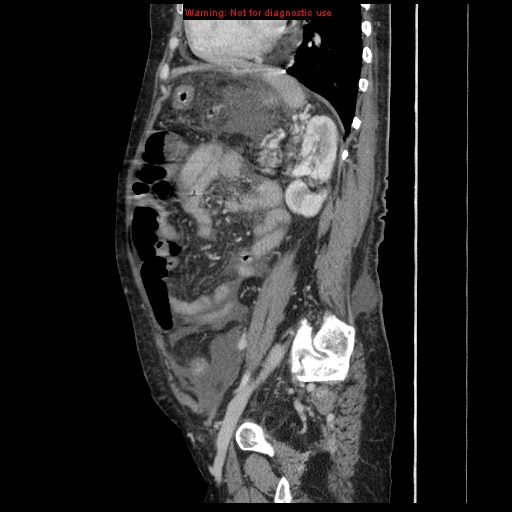 Abdominal wall hematoma (Radiopaedia 9427-10112 Sagittal C+ portal venous phase 35).jpg