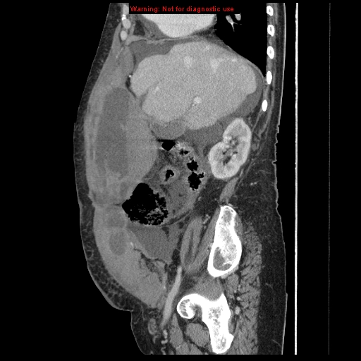 Abdominal wall hematoma (Radiopaedia 9427-10112 Sagittal C+ portal venous phase 73).jpg