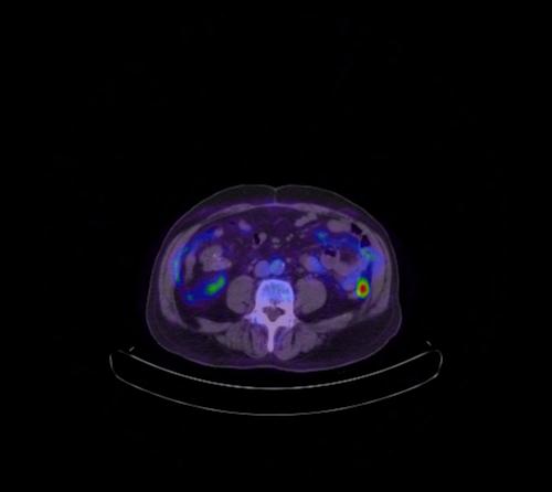 Abdominal wall metastasis from colorectal carcinoma (Radiopaedia 31016-31719 Axial 55).jpg
