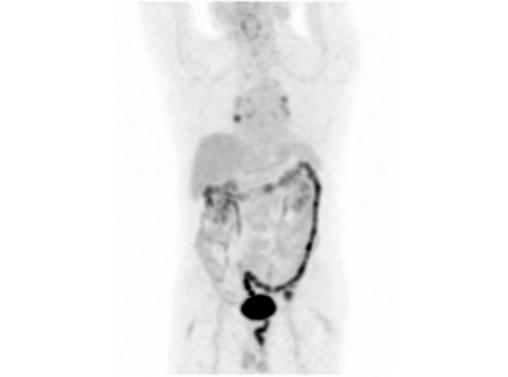 File:Abdominal wall metastasis from colorectal carcinoma (Radiopaedia 31016-31719 Rotational MIP 2).jpg