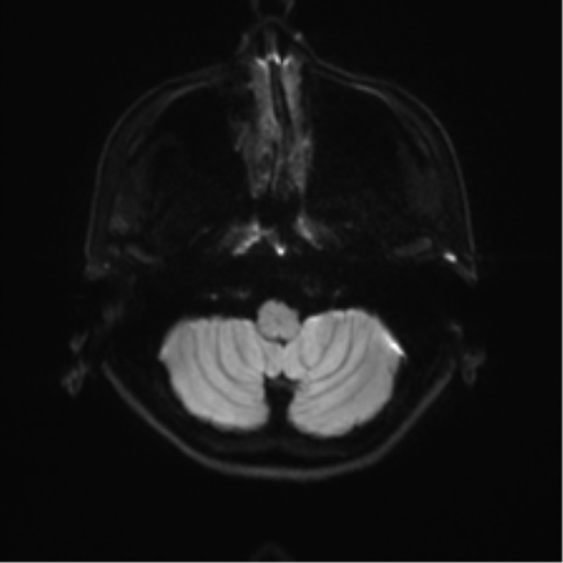 File:Abducens nerve palsy (Radiopaedia 51069-56648 Axial DWI 30).png