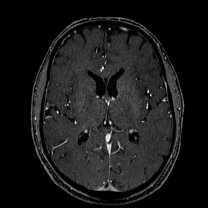 Accessory middle cerebral artery (Radiopaedia 73114-83828 Axial MRA 114).jpg