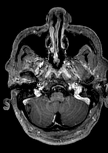 Accessory middle cerebral artery (Radiopaedia 73114-83828 Axial T1 C+ 156).jpg