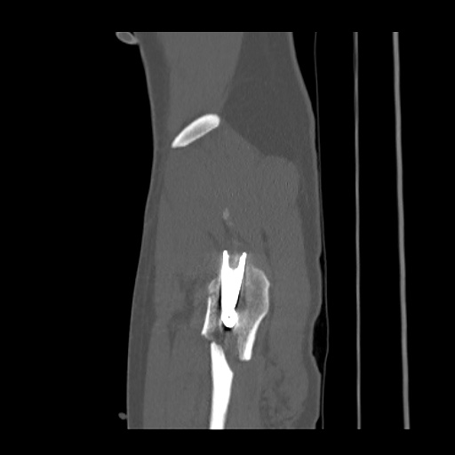 Acetabular and ilial fractures (Radiopaedia 59084-66378 Sagittal bone window 95).jpg