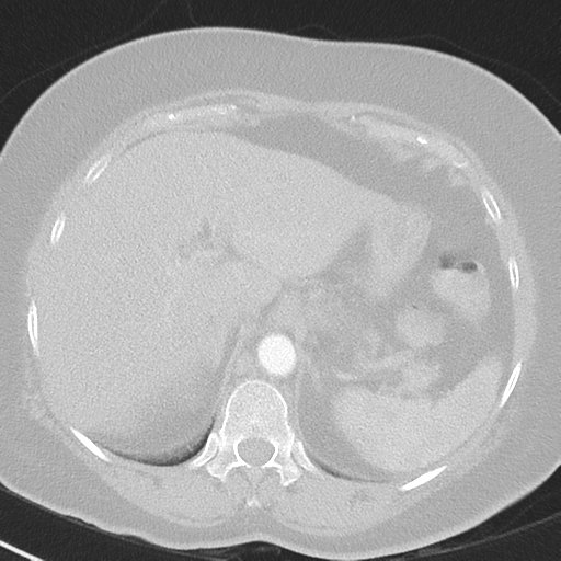 File:Achalasia (Radiopaedia 47147-51685 Axial lung window 46).png