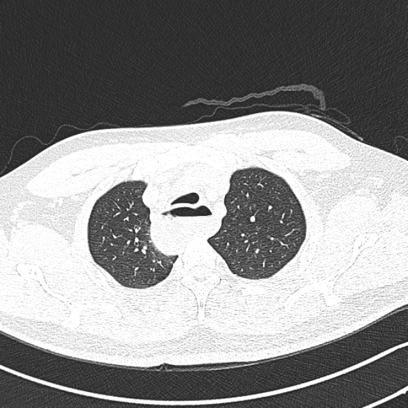 Achalasia with aspiration (Radiopaedia 55413-61845 Axial lung window 12).jpg