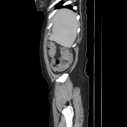 File:Acinar cell carcinoma of the pancreas (Radiopaedia 75442-86669 Sagittal C+ portal venous phase 37).jpg