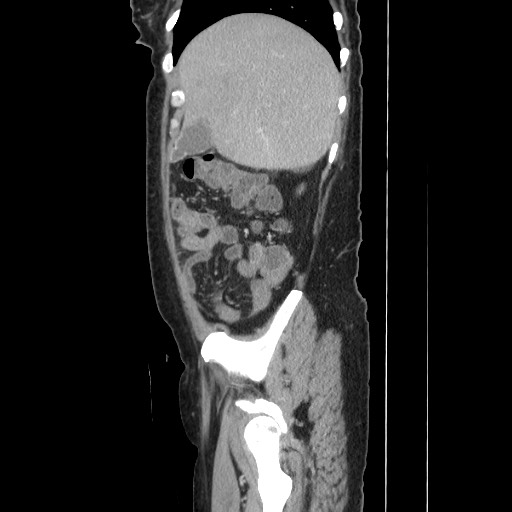 Acinar cell carcinoma of the pancreas (Radiopaedia 75442-86669 Sagittal C+ portal venous phase 50).jpg