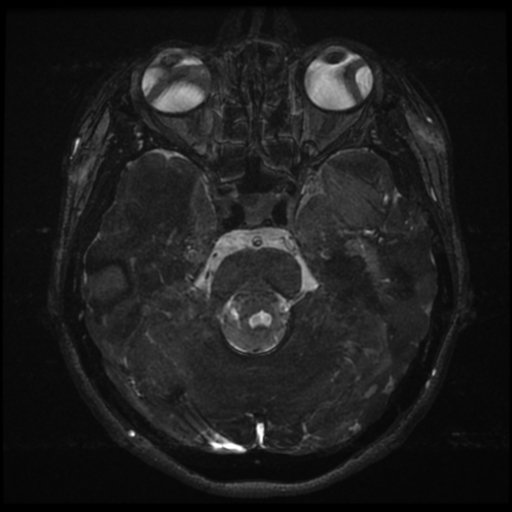File:Acoustic neuroma (Radiopaedia 34049-35283 Axial 80).png