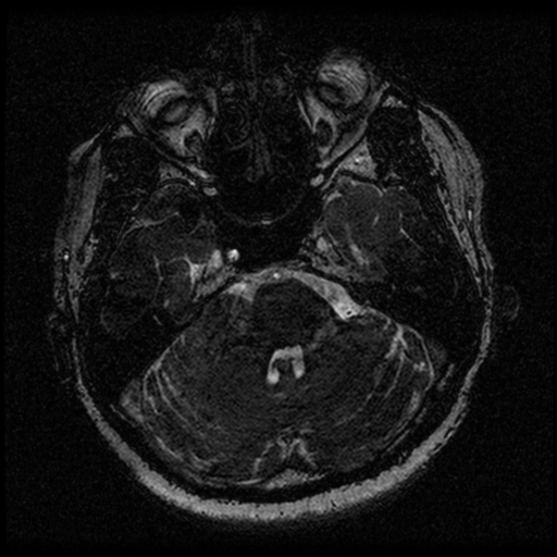 File:Acoustic schwannoma (Radiopaedia 33045-34060 Axial T2 37).png