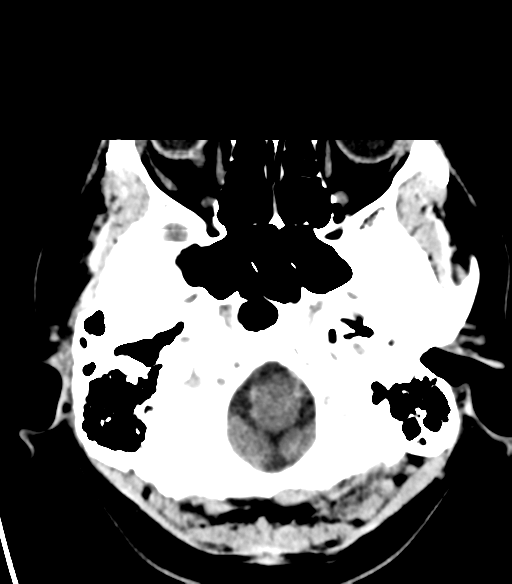 File:Acoustic schwannoma (Radiopaedia 33045-34065 Axial non-contrast 3).png