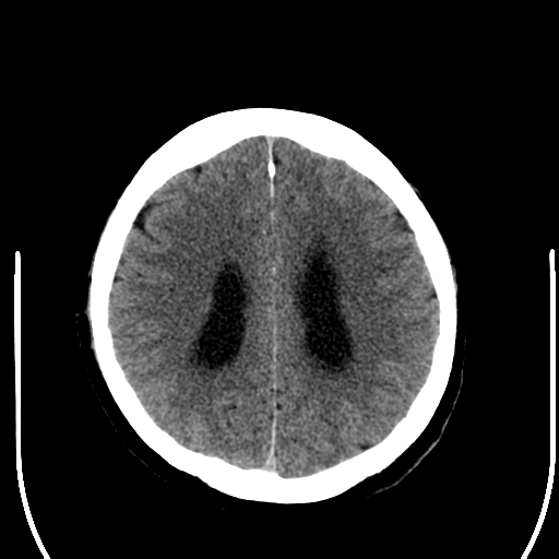 File:Acoustic schwannoma (Radiopaedia 39170-41389 Axial non-contrast 20).png