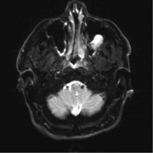 File:Acoustic schwannoma (Radiopaedia 50846-56358 Axial DWI 3).png