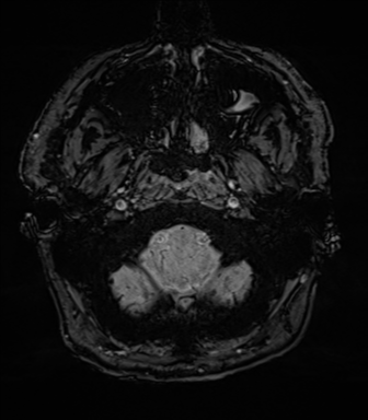 Acoustic schwannoma (Radiopaedia 50846-56358 Axial SWI 9).png