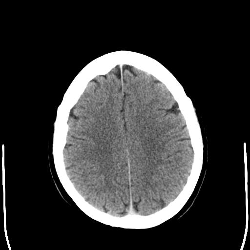 File:Acoustic schwannoma - cystic (Radiopaedia 29487-29980 AXIAL THICK non-contrast 20).jpg