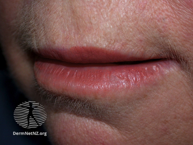 Actinic Keratoses affecting the face (DermNet NZ lesions-ak-face-259).jpg