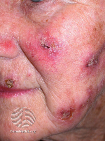 File:Actinic Keratoses treated with imiquimod (DermNet NZ lesions-ak-imiquimod-3762).jpg