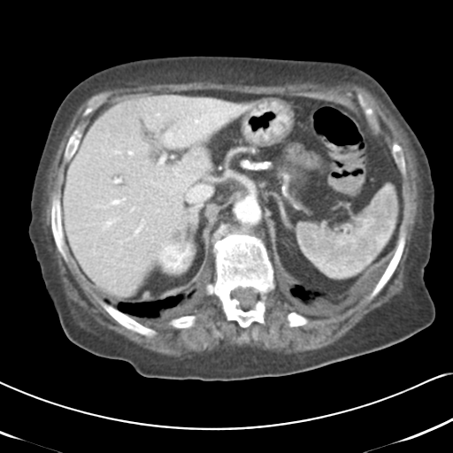 Active bleeding from duodenal ulcer with embolization (Radiopaedia 34216-35481 C 18).png