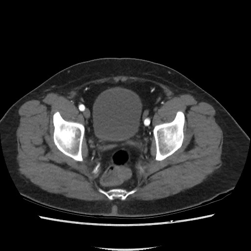 Active colonic bleed on CT (Radiopaedia 49765-55025 Axial C+ arterial phase 74).jpg