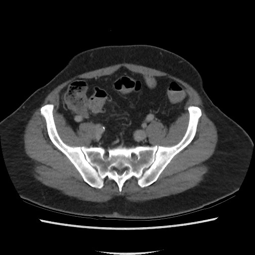 File:Active colonic bleed on CT (Radiopaedia 49765-55025 Axial C+ delayed 63).jpg