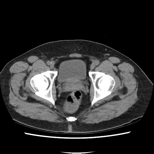 Active colonic bleed on CT (Radiopaedia 49765-55025 Axial non-contrast 79).jpg