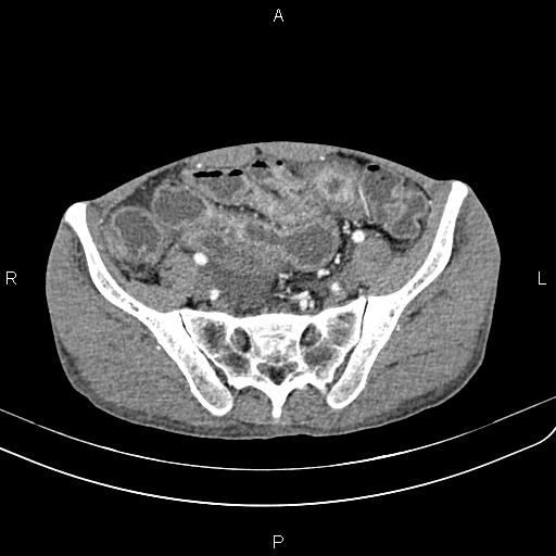 Active crohn disease (Radiopaedia 87133-103397 Axial C+ arterial phase 80).jpg