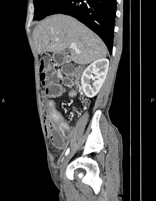 Active crohn disease (Radiopaedia 87133-103397 Sagittal C+ arterial phase 25).jpg