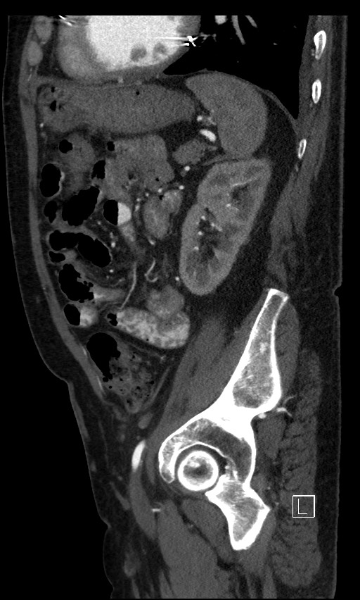Active lower gastrointestinal bleeding - diverticular (Radiopaedia 61203-69106 Sagittal C+ arterial phase 47).jpg
