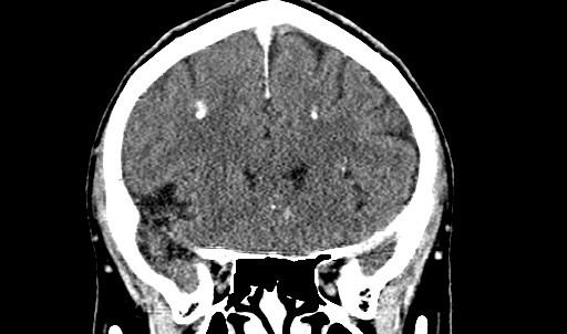 File:Active neurocysticercosis before and after therapy (Radiopaedia 71710-82099 Coronal C+ delayed 28).jpg