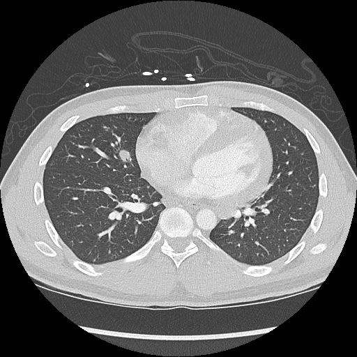 File:Active right ventricular cardiac sarcoidosis (Radiopaedia 55596-62101 Axial lung window 29).jpg