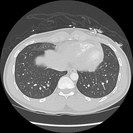 File:Active right ventricular cardiac sarcoidosis (Radiopaedia 55596-62101 Axial lung window 39).jpg