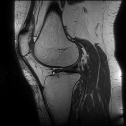 File:Acute-on-chronic transient lateral patellar dislocation with trochlear dysplasia (Radiopaedia 84099-99349 Sagittal PD 104).jpg