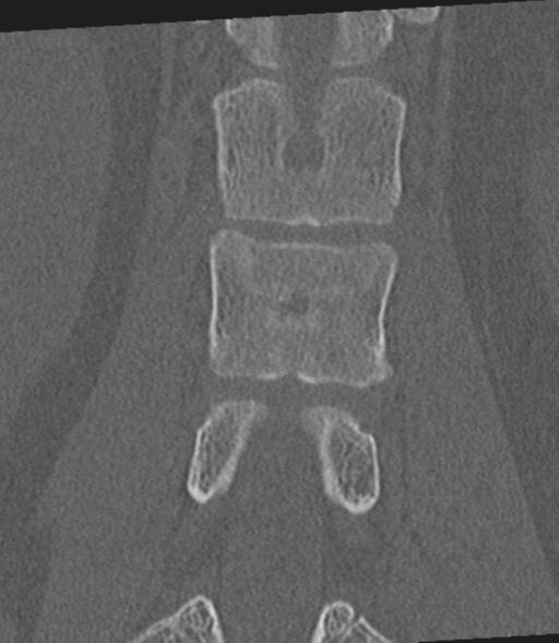 File:Acute L1 burst compression fracture (Radiopaedia 34430-35755 Coronal bone window 34).png
