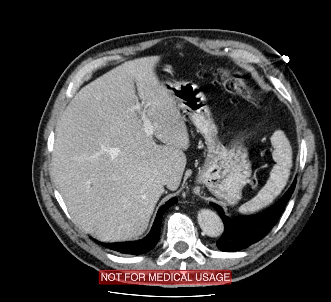 Acute aortic dissection - Stanford type A (Radiopaedia 40661-43285 Axial C+ portal venous phase 62).jpg